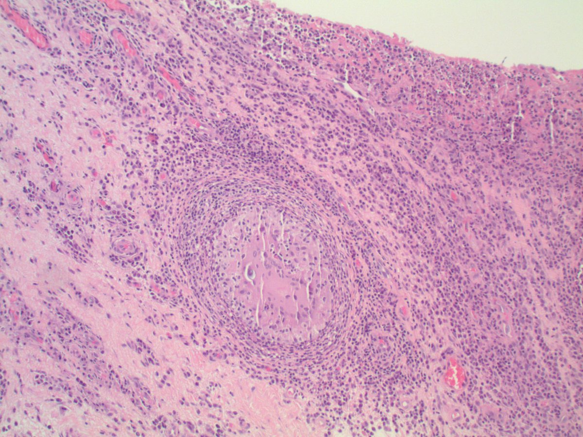 slusagar's tweet image. found this lil' treat while cleaning up my office:

knee synovium:  Cocci!😲#IDpath