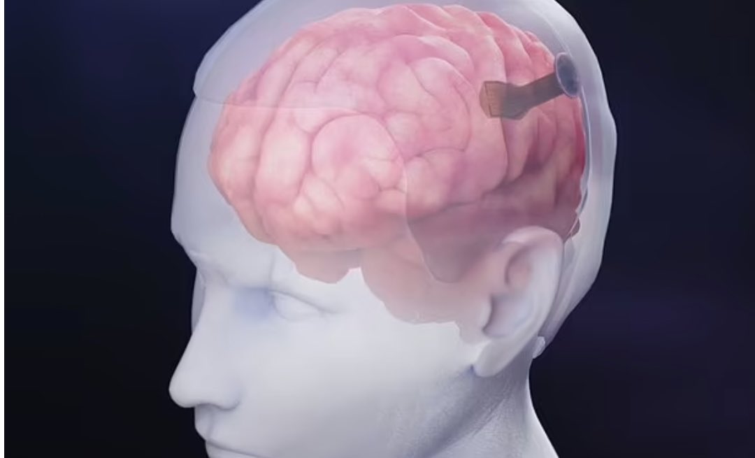 Brain implant thinner than a single human hair could allow you to use social media with your MIND 😳🤯