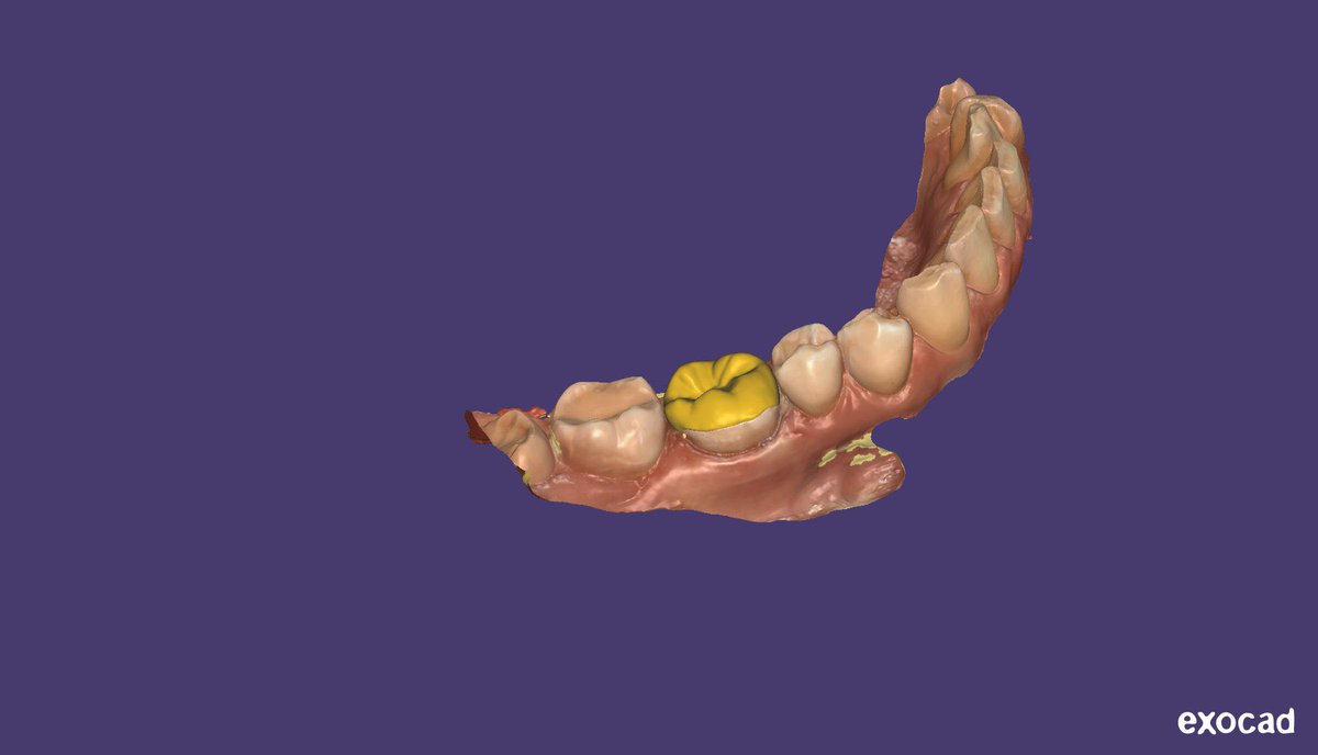 ExocadD's tweet photo. tab onlay - affects the inner slopes of the tubercles in the form of a cape. Anatomy of 46 tooth. My first job https://t.co/lFCiezumnB