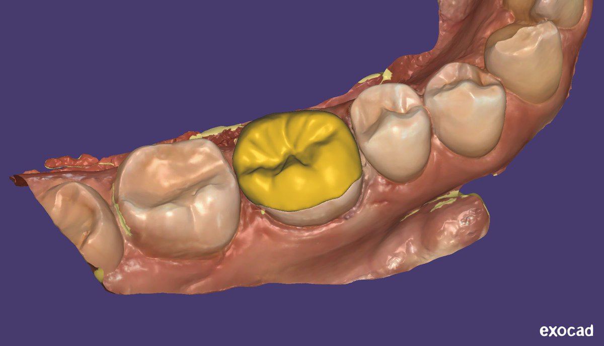 ExocadD's tweet photo. tab onlay - affects the inner slopes of the tubercles in the form of a cape. Anatomy of 46 tooth. My first job https://t.co/lFCiezumnB