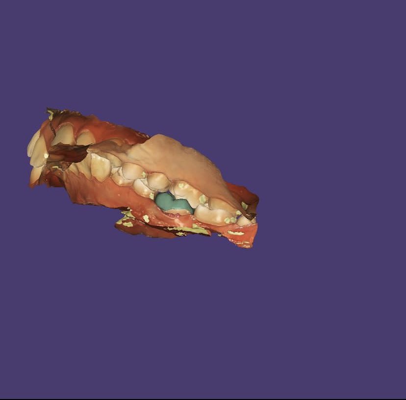 ExocadD's tweet photo. The final result of the onlay tab #CadCam #Exocad #tab #onlay https://t.co/HY0wMSziFf