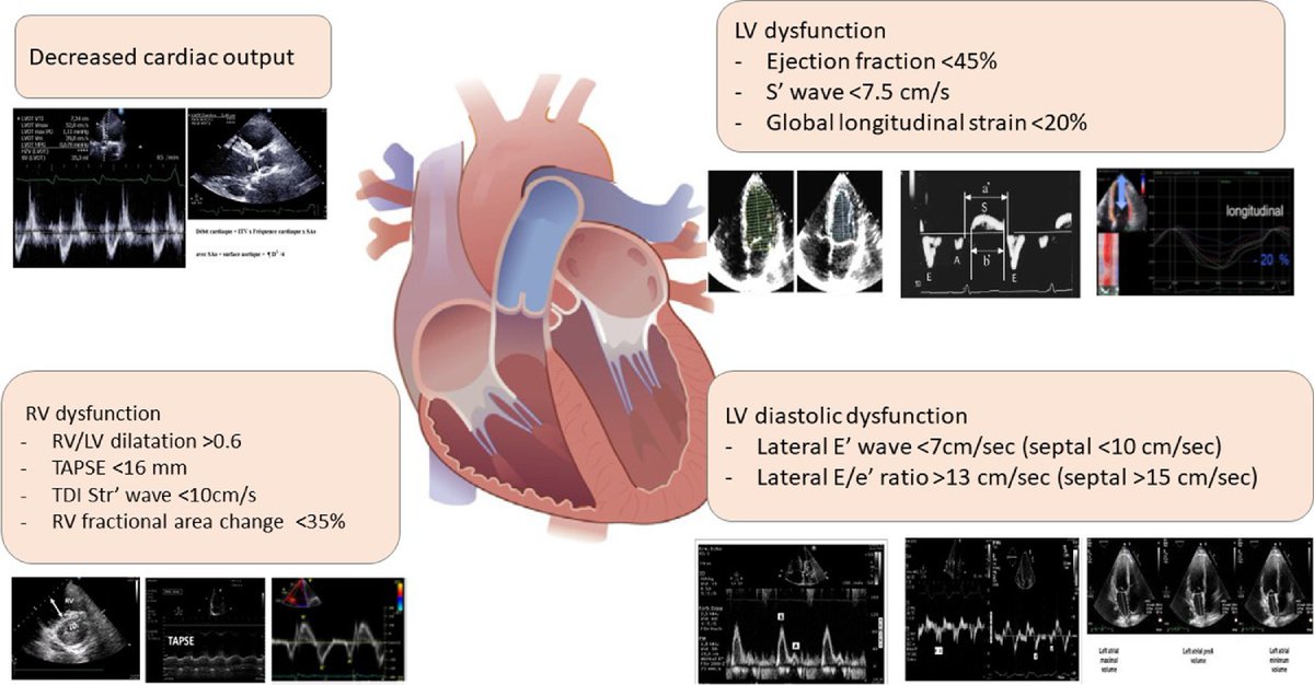 Septic cardiomyopathy review 🔗sciencedirect.com/science/articl…
#POCUS #MedEd #FOAMcc #echofirst