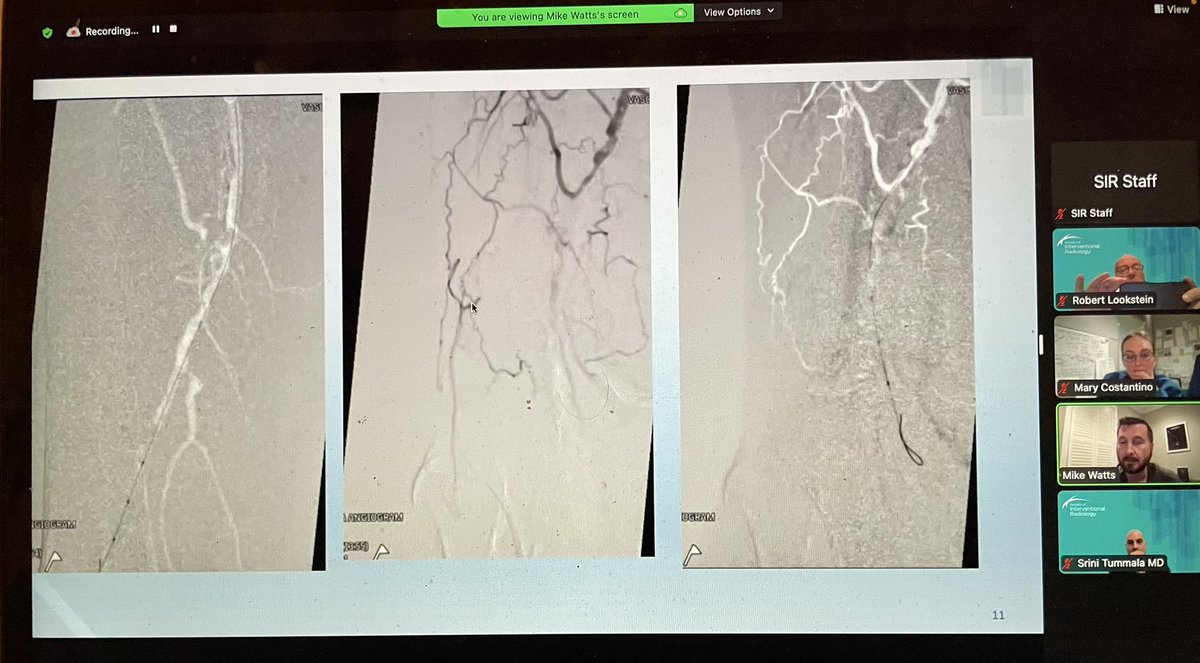 Live #LEARNplus webinar on atherectomy ATK…great cases by expert faculty @drcostantino1 @SriniTummala @Watts_IR @SIRspecialists