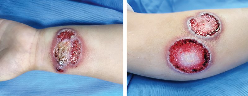 5-yr-old boy 

👉 with a h/o IgA vasculitis at 2 yrs of age 

 👉presented with a 1-m h/o progre painful skin ulcerations on his extremities

Diagnosis?

Cutaneous leishmaniasis 

Cutaneous polyarteritis nodosa 

Cutaneous tuberculosis 

Ecthyma gangrenosum 

Pyoderma gangrenosum