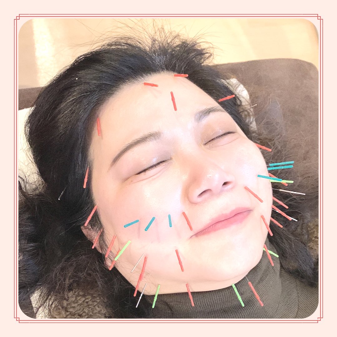yotsuba_aoc's tweet photo. 皆さん‼️
マスクを外す準備は出来ていますか😷⁉️

 #春日部  #整骨院  #美容鍼  #マスク  #脱マスク  #たるみ  #リフトアップ  #ほうれい線 https://t.co/6aGcVXMG2i