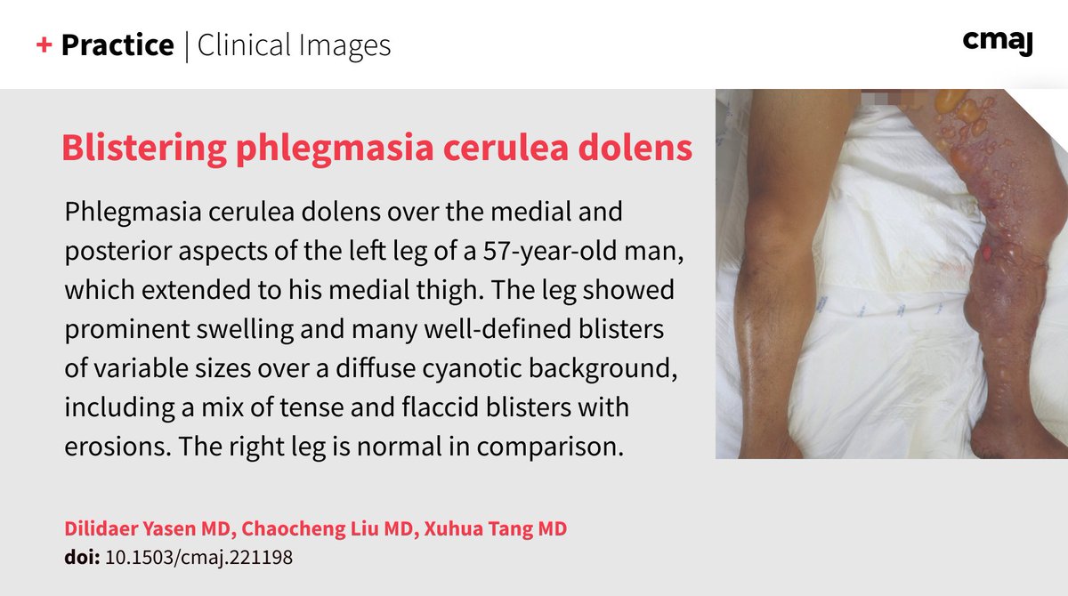 Blistering phlegmasia cerulea dolens:
An uncommon condition whereby a massive DVT causes venous drainage obstruction ➡️ cmaj.ca/lookup/doi/10.…