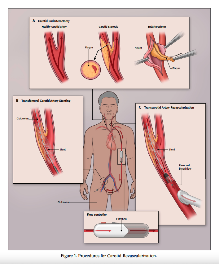 What is the role of transcarotid artery revascularization in the treatment of carotid stenosis? Jesse A. Columbo, MD, MS, and @DHStoneMD tackle this question in the latest Tomorrow’s Trial. eviden.cc/3IGN9Q7 #CardioTwitter #MedTwitter #ClinicalTrials #MedEd