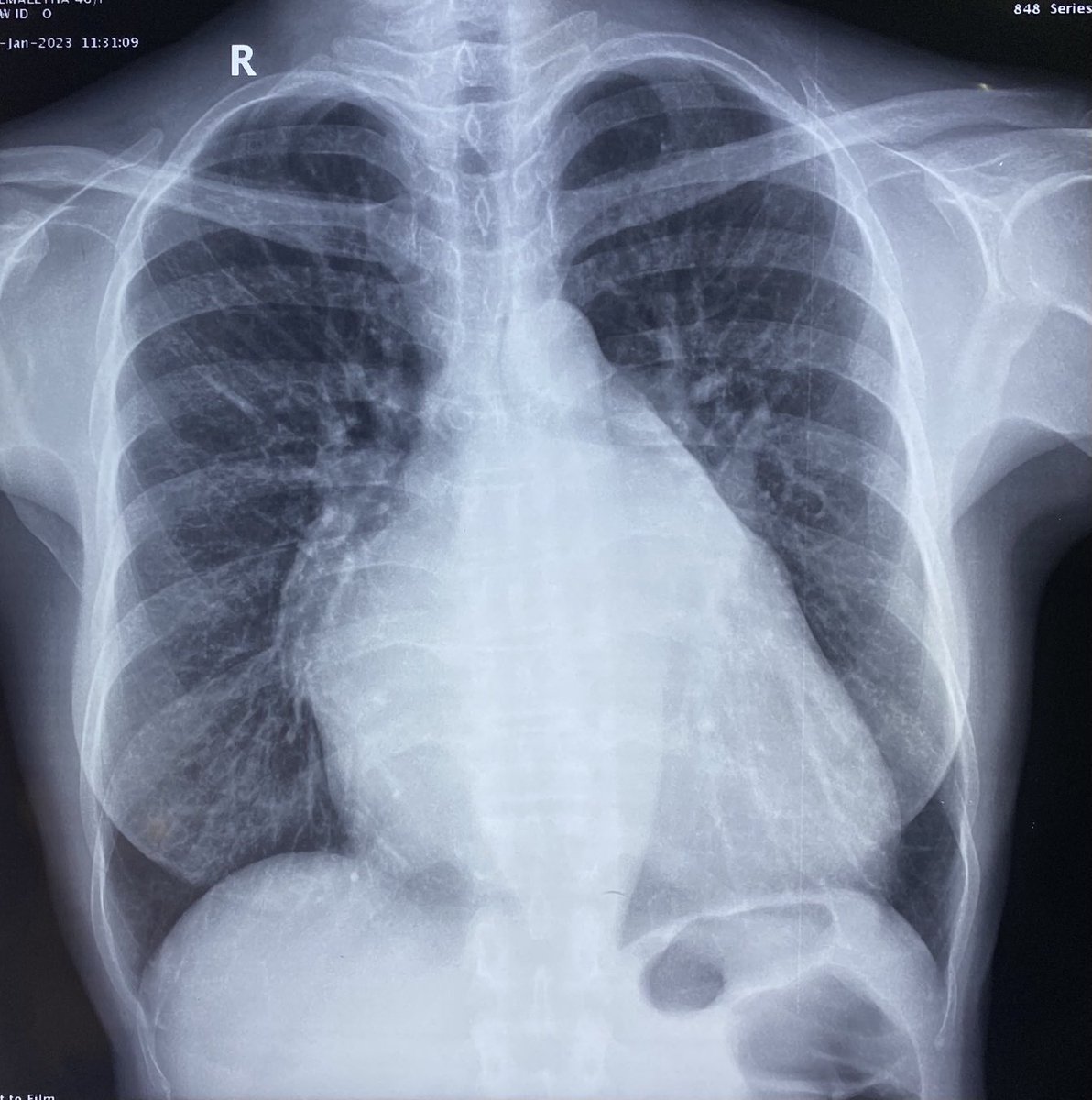 DrRajeshG1's tweet photo. For residents. Findings? Most probable diagnosis? https://t.co/3dcHyAF1nR