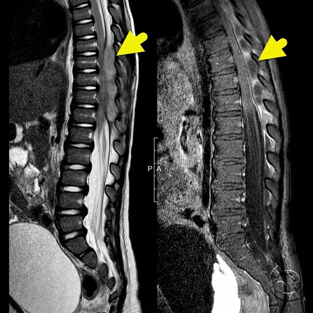 CincyKidsRad's tweet photo. Sagittal T2 (left, image 1) and T1 post contrast MRI (right, image 1) of the thoracic and lumbar spine show a large epidural abscess (arrow). Diffusion weighted image (left, image 2) and ADC map (right, image 2) confirm abscess with presence of restricte… https://t.co/AGTwxo4BuO https://t.co/t6rErv3T41