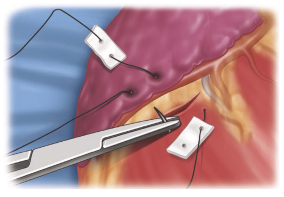 Dr Luis Felipe Cabrera Vargas MD FACS tweet media