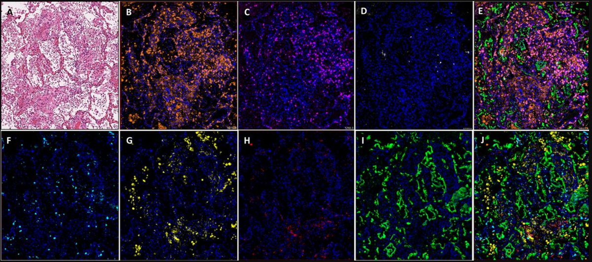 Delighted to share our new <a href="/QubPMC/">PMC</a> study on #SARSCoV2's impact on the adaptive immune response. A validated multiplex immunofluorescence (#mIF) protocol using <a href="/AkoyaBio/">Akoya Biosciences</a> chemistry enables molecular physiopathology exploration in autopsy materials. bit.ly/40oqr5N