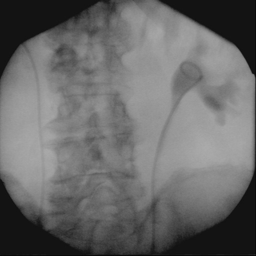 Double J stent procedure in a patient with bladder cancer, and my very first as an IR resident. So pleased to have done it. 😊 #medtwitter #IRtwitter #neurorad #radres #FOAMed  #IR #radtwitter