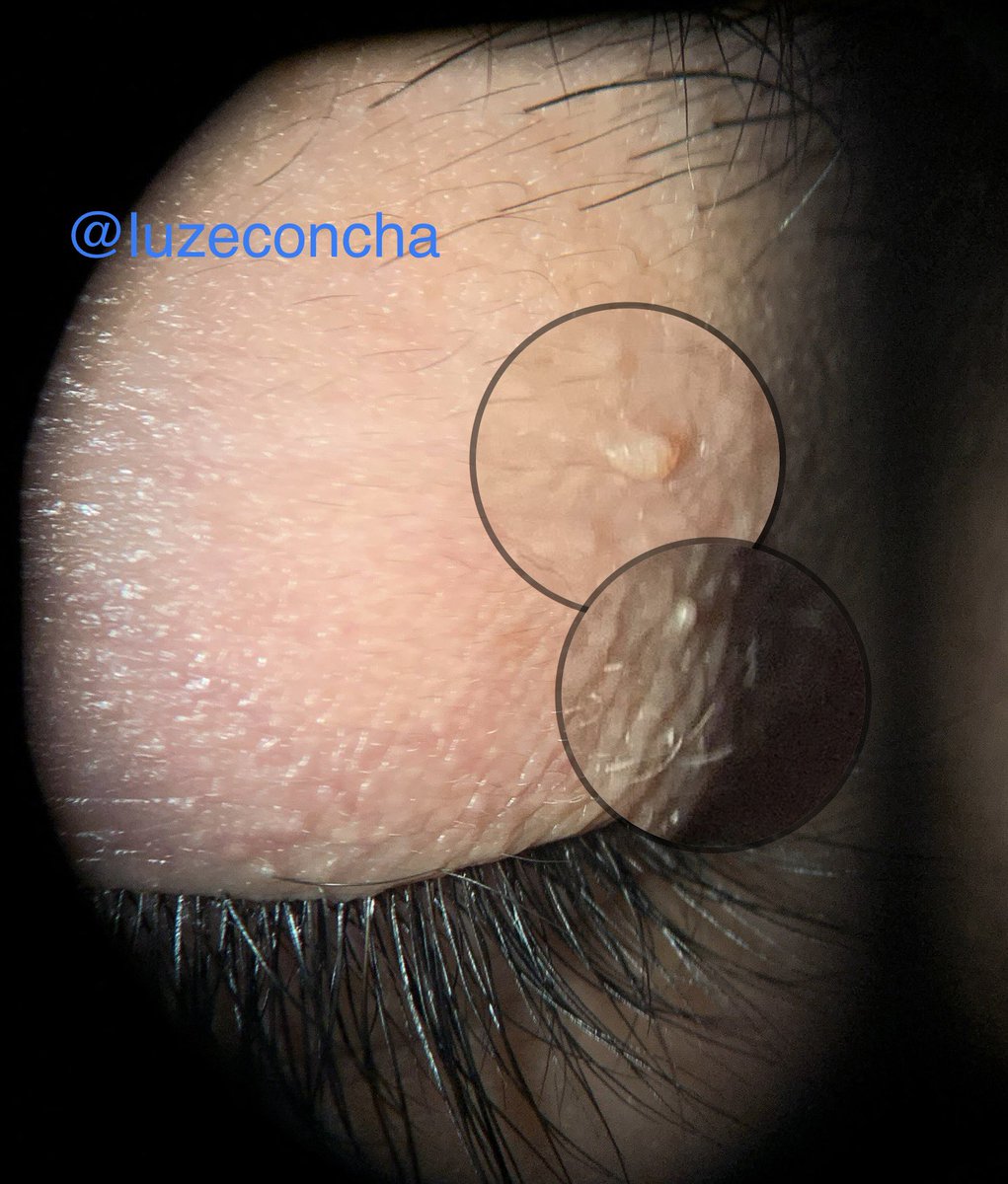LuzEConcha's tweet photo. Papiloma palpebral 👁️👁️
Uno de los tumores palpebrales más frecuentes en pacientes de mediana edad o ancianos. 
Es indoloro, solitario o múltiple, liso o áspero y similar en color a la piel adyacente.
Necesita evaluarse para ver a cuál causa #papiloma #VPH https://t.co/SOgHDtzi3y