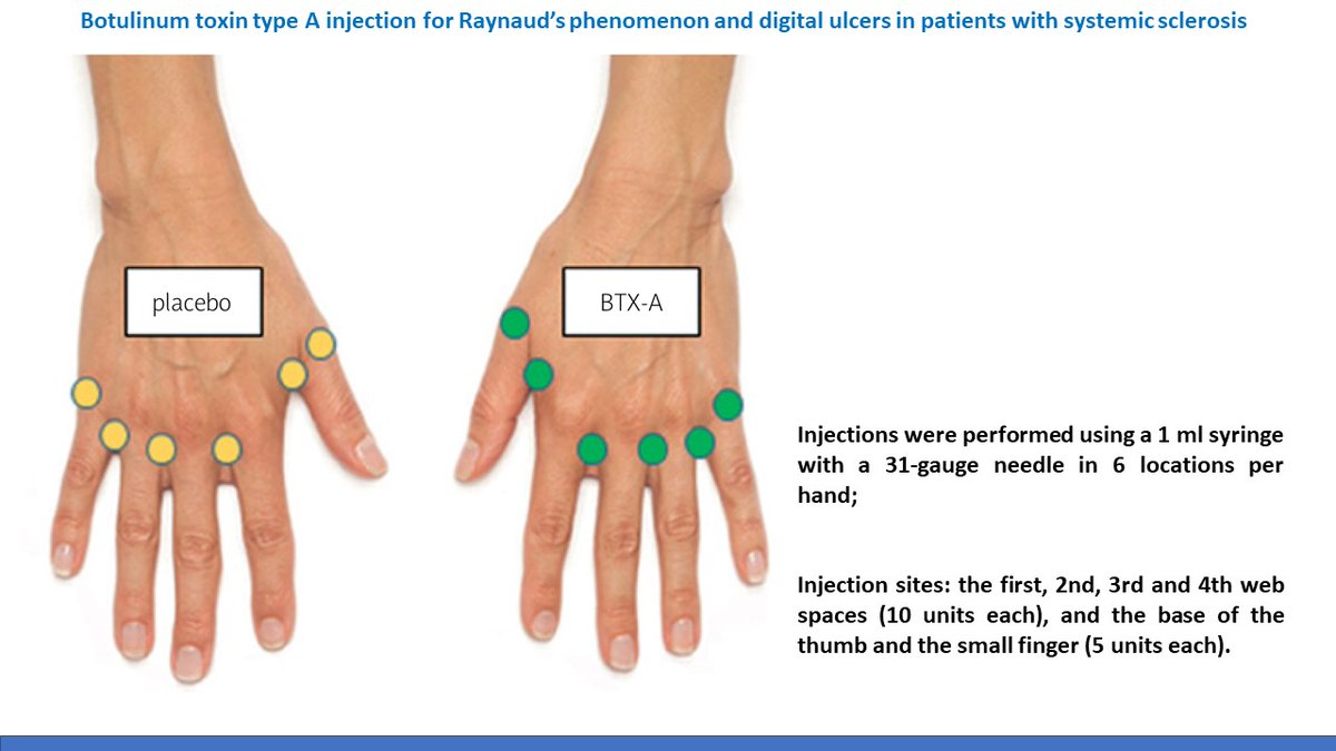 NEW 🔥Local botulinum toxin type A injection has beneficial therapeutic effects on Raynaud’s phenomenon and digital ulcers in patients with #SystemicSclerosis
👉bit.ly/3JPfx3t