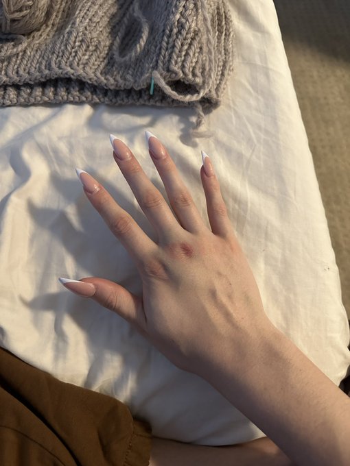 Could definitely be worse 😋 i was being a baby https://t.co/eV3rG39yhN<a href="/tag/cancelcanadaday"class="tags"><span>#cancelcanadaday</span></a>