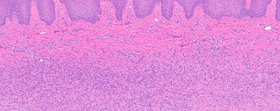 MhPathology's tweet image. Dermatofibroma (DF).
A 20-year-old female with well-defined red-brown firm papule on dorsal surface of the foot.

Case by @MalekAsfarMD 

Click ALT for more details.

#pathology #pathologists #patholo #dermpath #dermtwitter #dermatology #dermatologia @ASDPTweets @IntSocDermpath