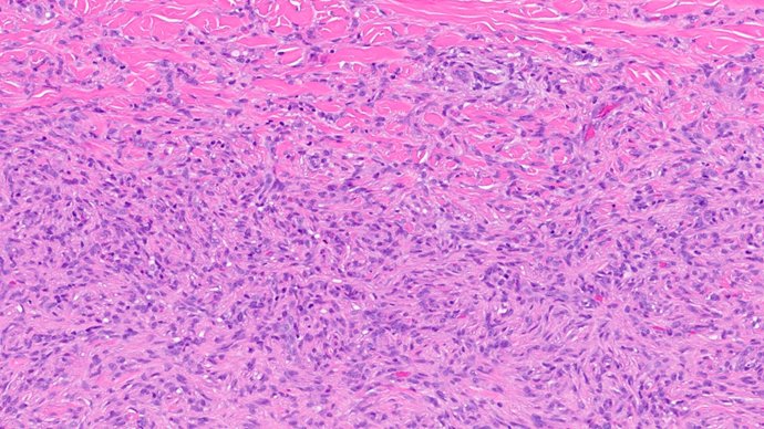 MhPathology's tweet image. Dermatofibroma (DF).
A 20-year-old female with well-defined red-brown firm papule on dorsal surface of the foot.

Case by @MalekAsfarMD 

Click ALT for more details.

#pathology #pathologists #patholo #dermpath #dermtwitter #dermatology #dermatologia @ASDPTweets @IntSocDermpath