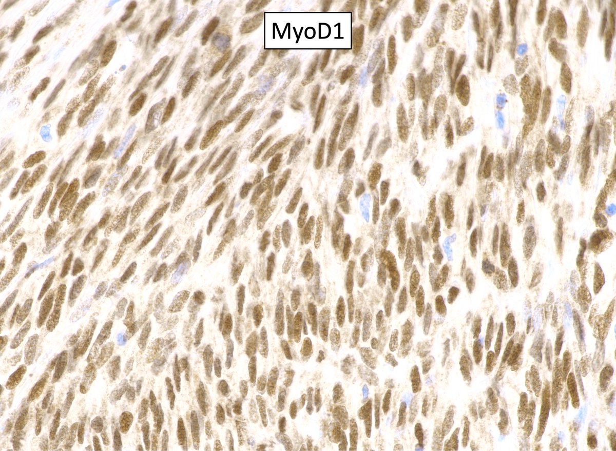 Spindle cell rhabdomyosarcoma is often overlooked because of very limited desmin and myogenin expression, as in this MYOD1 L122R variant. MYOD1 IHC is the most sensitive marker in this morphological setting. #BSTpath