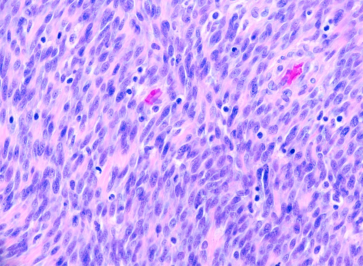 Jerad Gardner, MD on Twitter "RT Greg_Charville Spindle cell