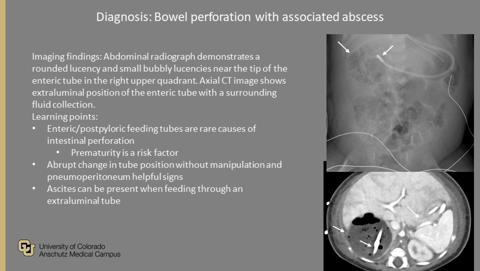 PedsRadsColo's tweet photo. @PedsRadsColo Weekly #QualityRounds:
Neonate with bloody stools and bacteremia
#ImagingOurFuture #PedsRad #MedEd #RadRes #FOAMrad #FOAMed #GoodCall #PeerLearning #RadTwitter
@COpediatricEM @SocPedRad @CURadiology @curadresidents https://t.co/gwKZbRXeCO