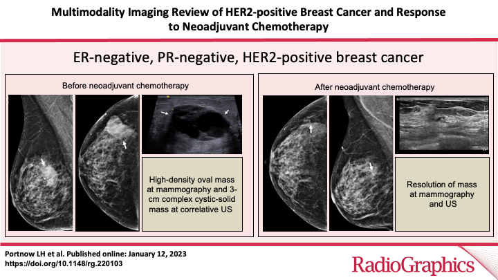 RadG_Editor's tweet photo. Multimodality Imaging Review of HER2-positive Breast Cancer and Response ​to Neoadjuvant Chemotherapy
Portnow LH et al
Breast Imaging
https://t.co/QJWILDy4LY

@leahportnowmd
@SchikarmaneMD
#RGphx
2/12 https://t.co/HKplJiM9gH