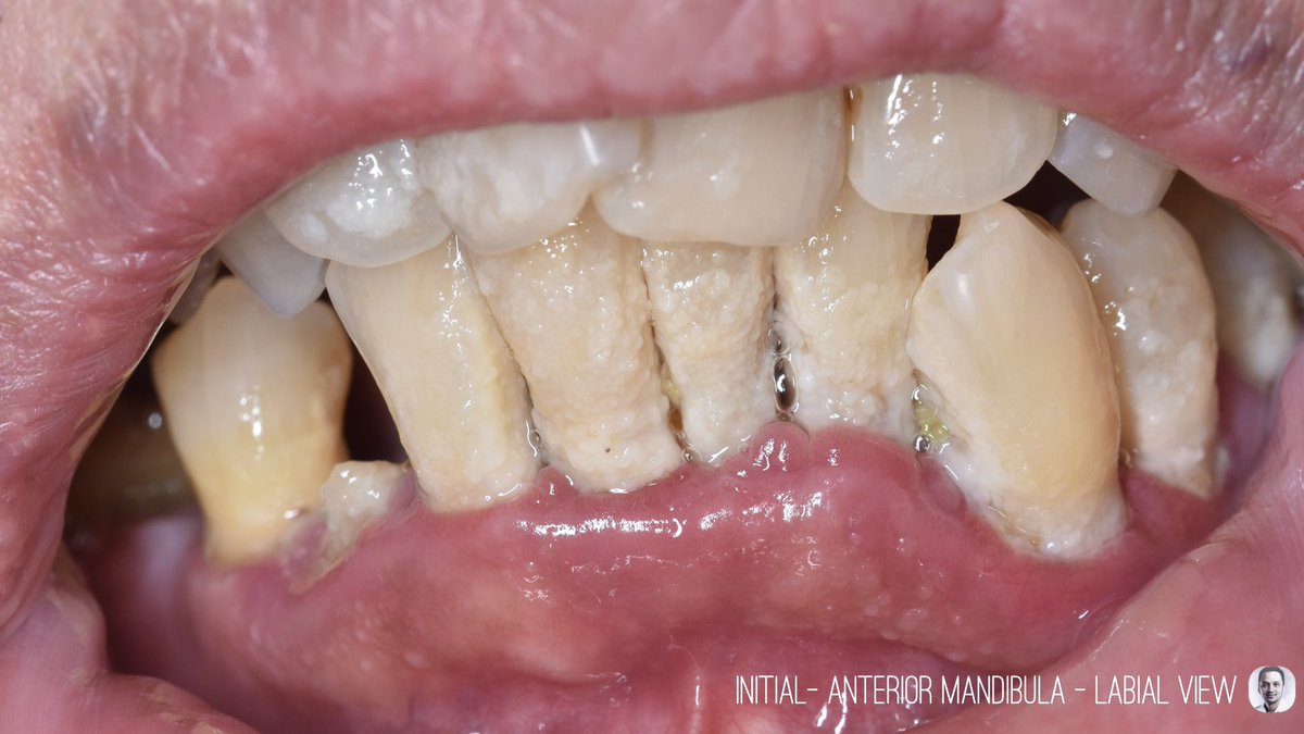 Selamat Pagi Temans Twitter, coba ngaca dulu jangan” dimulut kamu ada gambaran spt ini?, ada namanya sisa makanan atau debris, plak atau bahkan kalkulus yang nama lainnya karang gigi?, keluhannya sih biasanya gusinya sering berdarah, pernah gak?