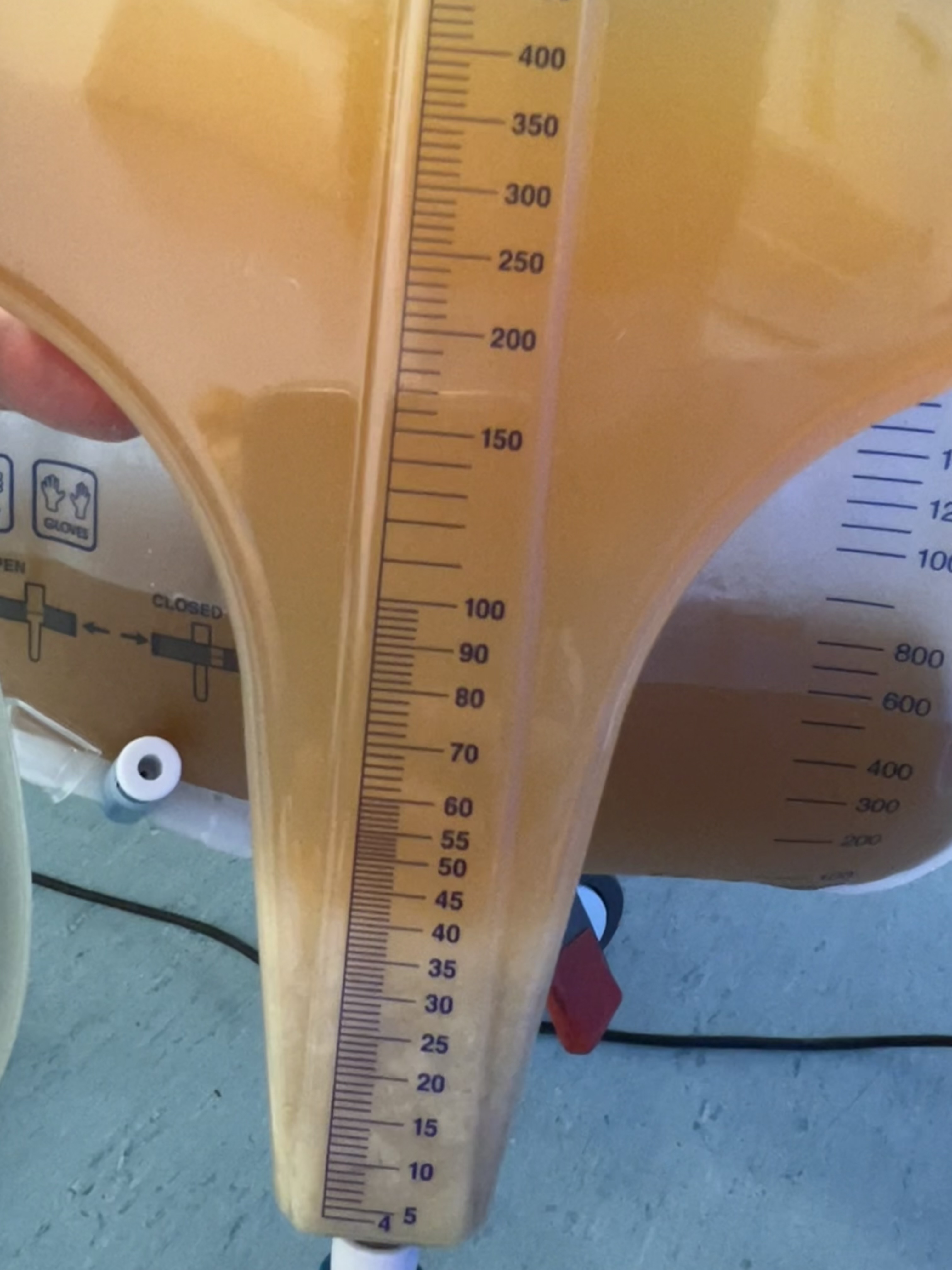 Keith Siau on X: "The white sediment at the bottom of the catheter specimen  is pus - this is known as pyuria. This patient had a UTI and  rhabdomyolysis. Note the background