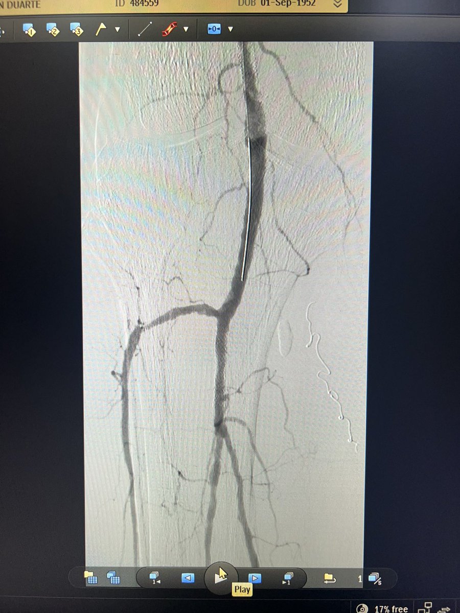 ChaconMatoso's tweet photo. 70 Y/o, male, hypertensive, diabetic, coronary artery disease, evolving with acute arterial occlusion due to intra stent thrombosis.  Performed thrombectomy with Rotarex, ballooning with balloon with drug. #angiovascularteam #Endovascular https://t.co/ulxgw5joQc