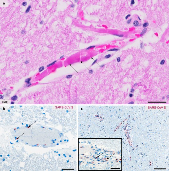 The first reports of the presence of coronavirus in the central nervous system in COVID-19 pediatric patients, emphasizing the neurotropism and neuroinvasion characteristics of the virus. bmcpediatr.biomedcentral.com/articles/10.11…