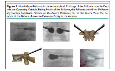 ORTOJ2's tweet photo. "Balloon Kyphoplasty: Cement Augmentation in Acute Osteoporotic.." by Abdulrazzaq Alobaid, MD, FRCSC [ISSN 2473-0963]

Read the entire article here: https://t.co/nPvKQPkqDO

Manuscript submission: https://t.co/wgDfyGkJnd

#openventio #OpenAccess #Orthopedics #Kyphoplasty https://t.co/01LK51SAgB