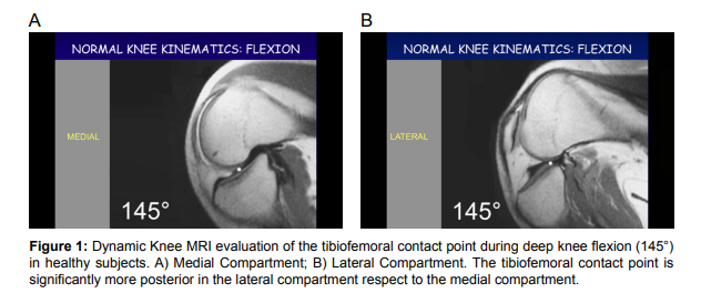 ORHOJ1's tweet photo. #minireview "Is Normal Knee Biomechanics Reproduced by Modern Total Knee.." by Pier Francesco Indelli, MD, PhD

Read the entire article here: https://t.co/36z2D9NXHW

Click here to submit the manuscript: https://t.co/aPIYLkWtKd

#openventio #openaccess #Osteology  #Rheumatology https://t.co/wt89rnWTx6