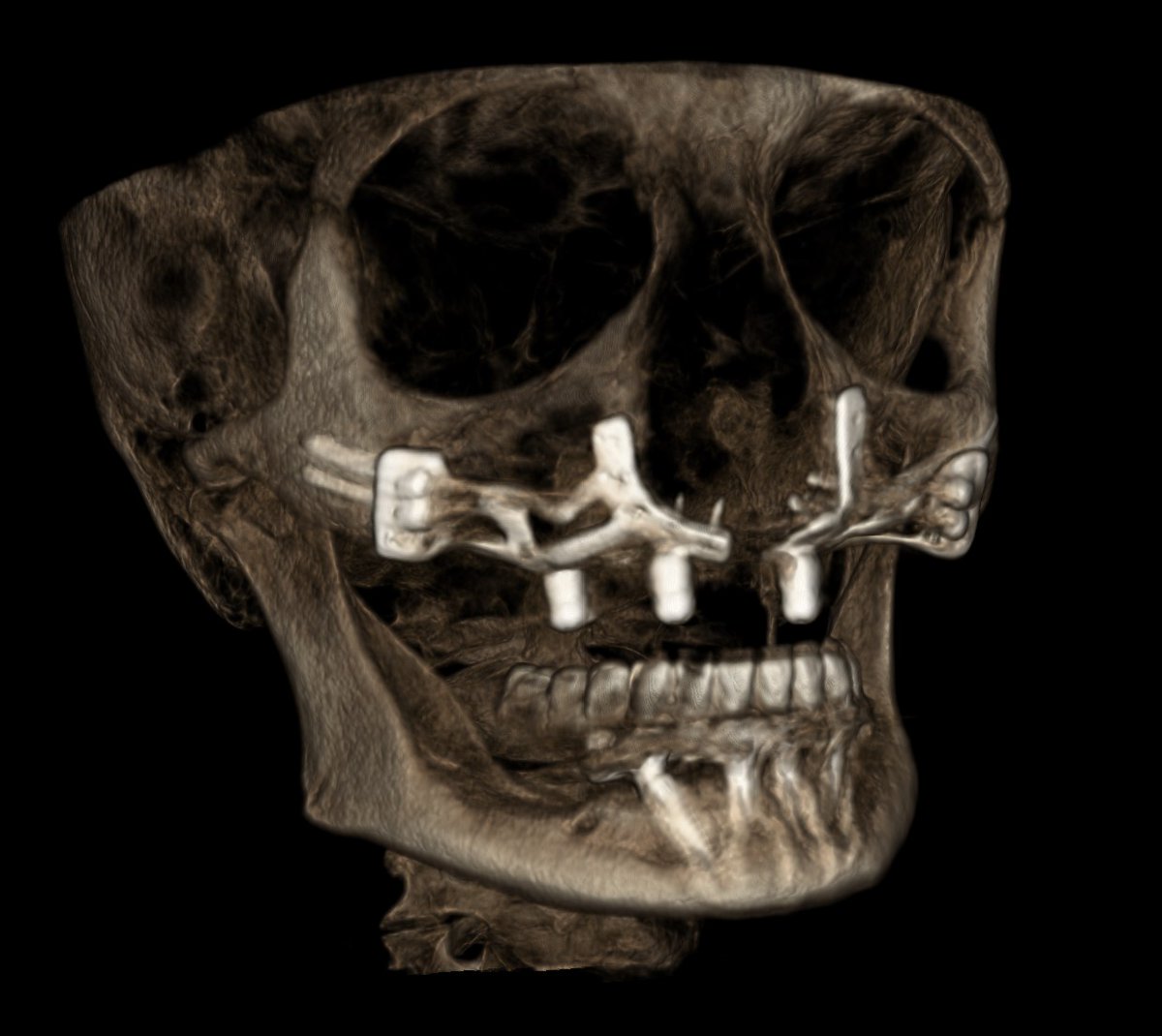 boneeasy's tweet photo. #Implantizecompact the solution for every atrophic cases, and we mean every case, always same day teeth https://t.co/T2NZ4GLqhm
