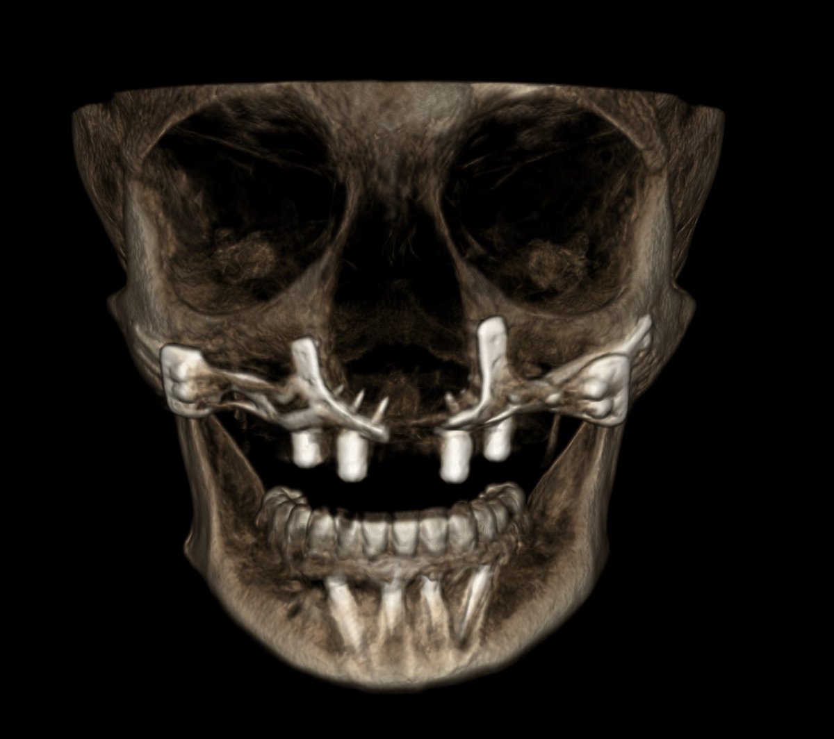 boneeasy's tweet photo. #Implantizecompact the solution for every atrophic cases, and we mean every case, always same day teeth https://t.co/T2NZ4GLqhm