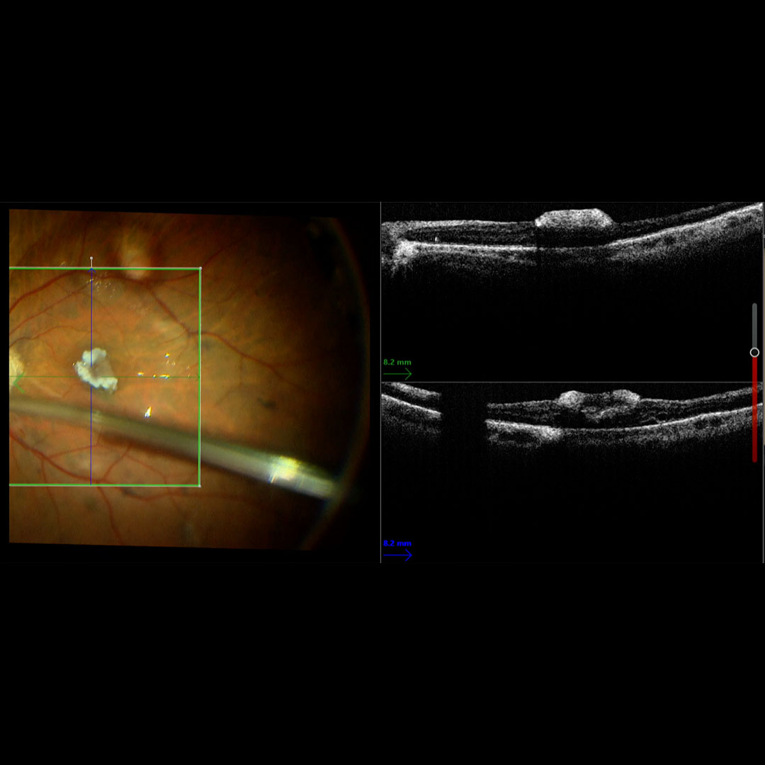 Leica Microsystems on Twitter "☑️Do you perform Macular Hole surgery