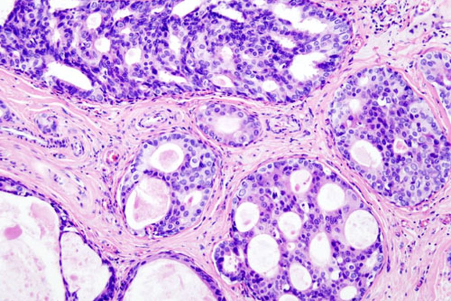 QuePasaCL's tweet photo. Cáncer de mama triple negativo: personas diagnosticadas promedian 55 años  https://t.co/NHHJ1Vj2XC https://t.co/9RrDwHE5gQ