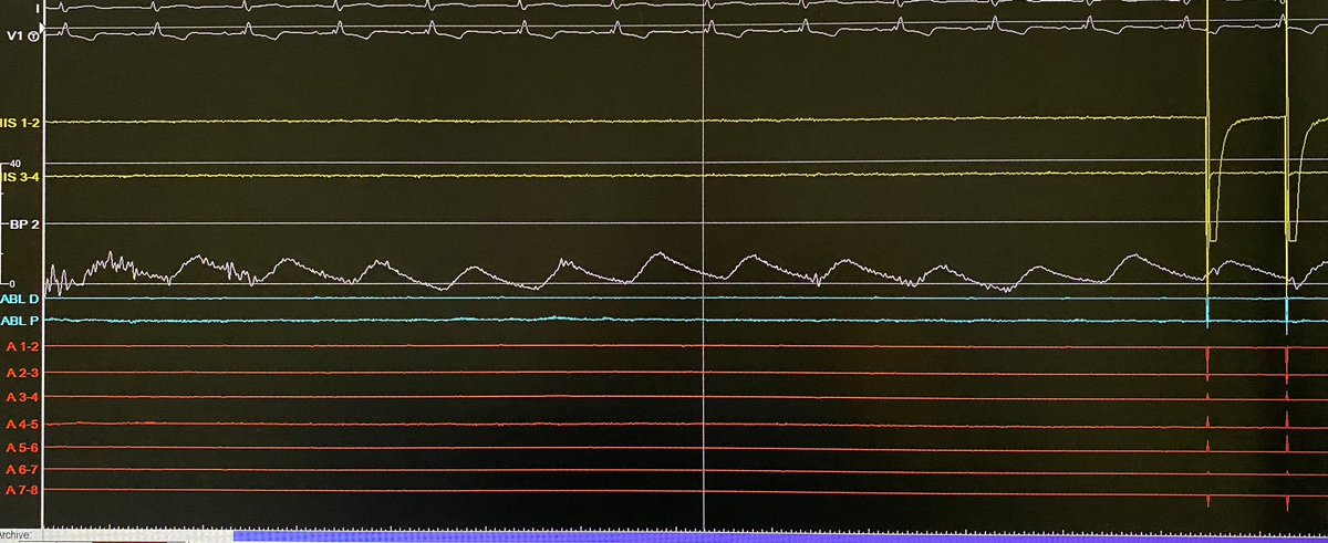 #EPeeps Interesting method from @Arritmias_H12O and @AdolfoFontenla to reduce fluoroscopy time and dye during cryoablation of pulmonary veins (PV). White line showing PV pressure’s curve when total occlusion is achieved. Congrats!