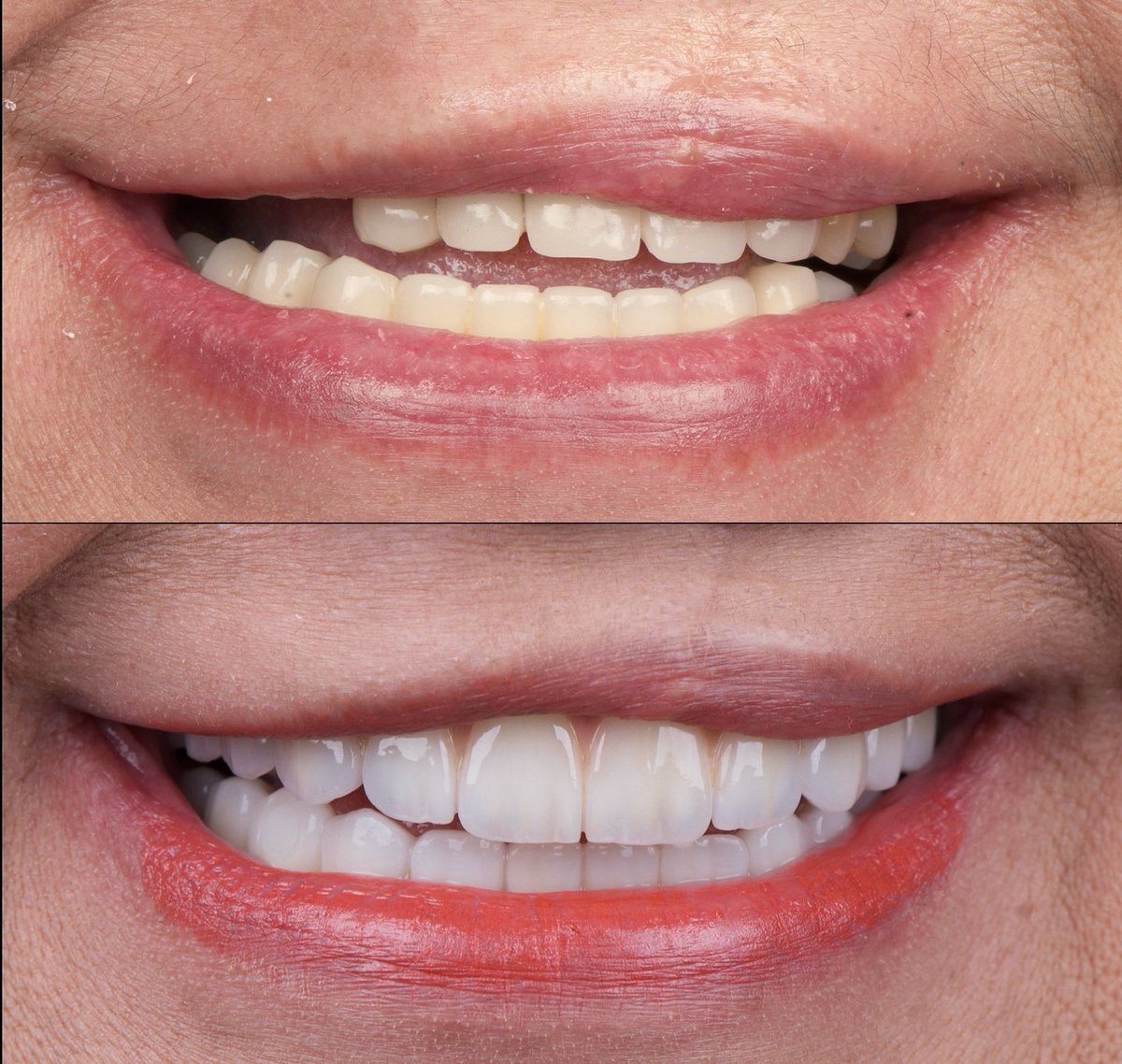 حالة تم علاجها بعد معاناه طويلة من سوء العلاج بسبب وجود مرض خلقي يعرف باسم الشفاه الارنبية بفضل الله تم استعادة الابتسامة والعضة الصحيحة بعمل زرعات وتركيبات ثابته 
<a href="/dentalhousec/">Dental House Clinics</a>