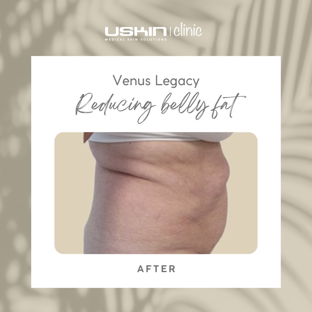 Swipe naar links voor het prachtige resultaat na enkele behandelingen met Venus Legacy voor omtrekvermindering!  

#uskintheclinic #huid #huidverbetering #huidverjonging #gezond #venus #legacy #aandacht #omtrekvermindering