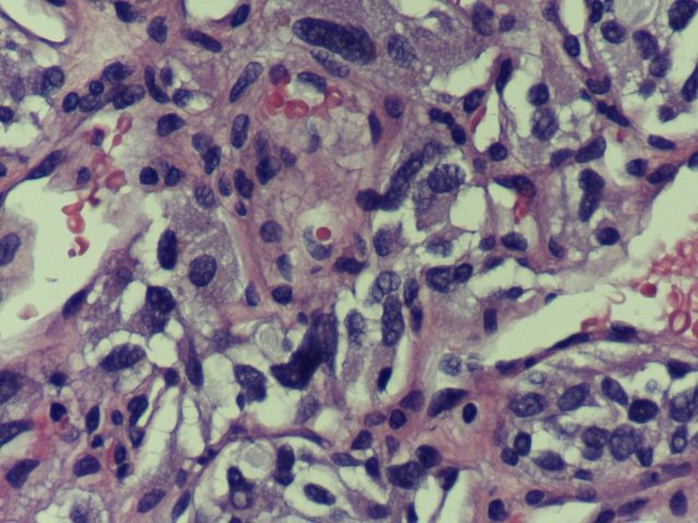 A 58 year old gentleman was found  to have a 2 cm right anterior urinary bladder exophytic mass. TURBT was performed.
What is your opinion?
#GUpath
#Pathology
#Pathtwitter
#Pathresidents