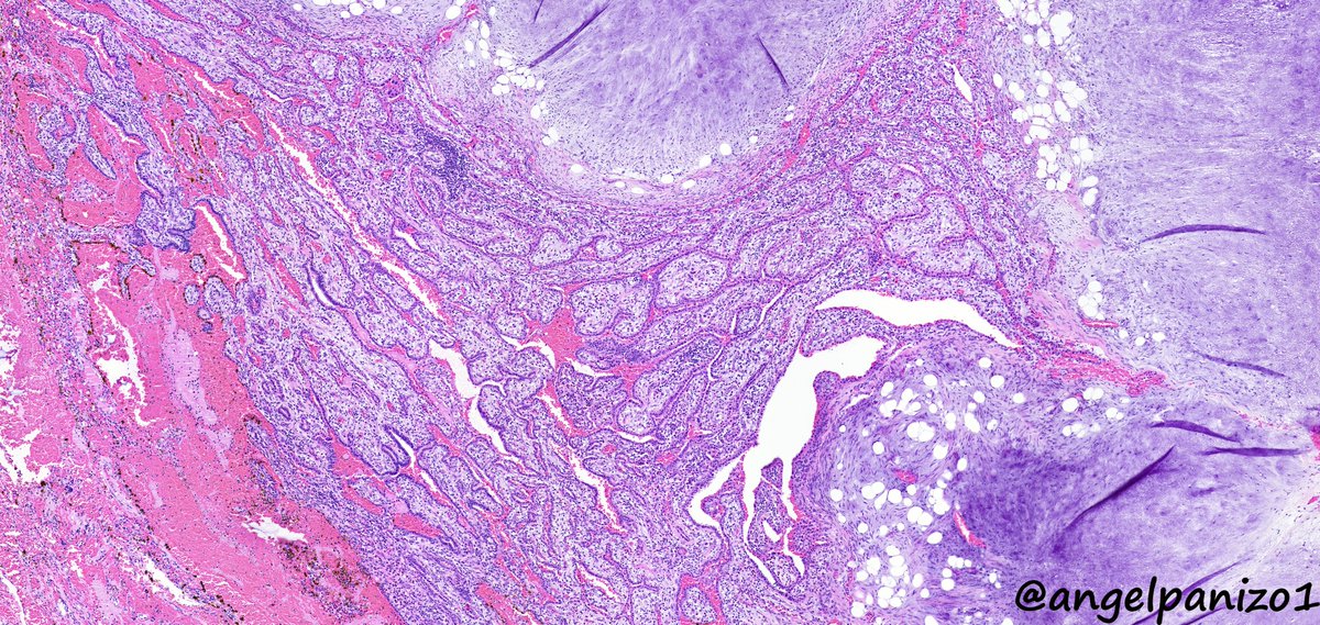 angelpanizo1's tweet image. Incidental lung tumor... pulmonary hamartoma with unusual morphology?... what is your opinion? (2⃣) #PathTwitter  #pulmpath @smlungpathguy @SansanoValero @yro854 @natasharekhtman @mkbaine @atman_ci @Path_Matt