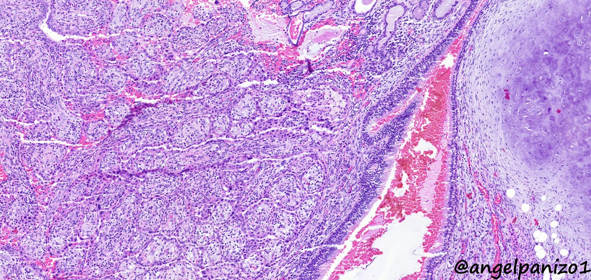 angelpanizo1's tweet image. Incidental lung tumor... pulmonary hamartoma with unusual morphology?... what is your opinion? (2⃣) #PathTwitter  #pulmpath @smlungpathguy @SansanoValero @yro854 @natasharekhtman @mkbaine @atman_ci @Path_Matt