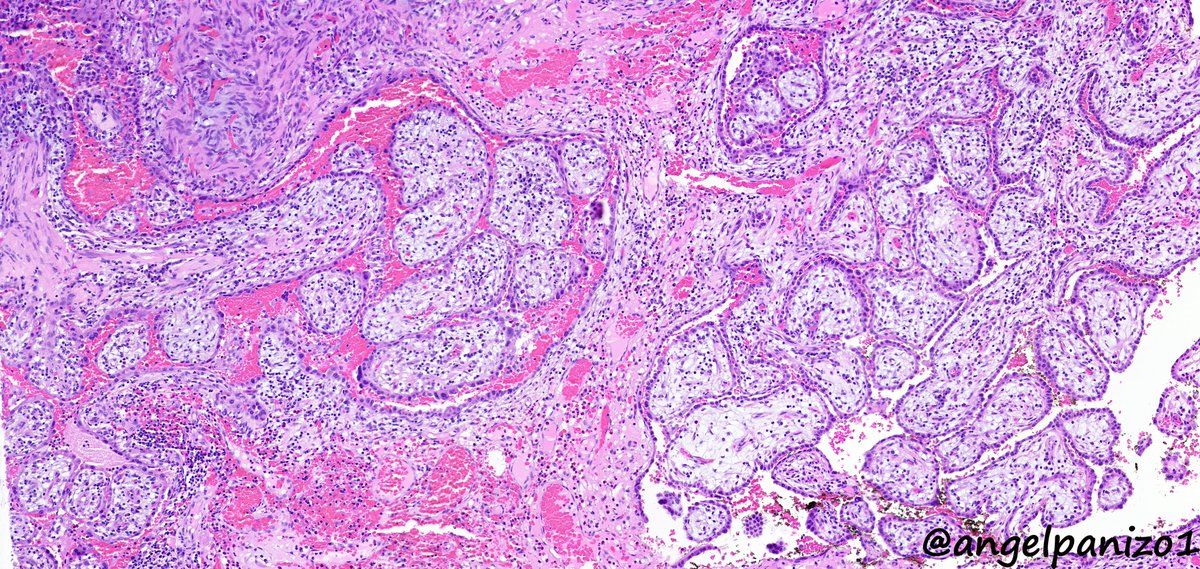 angelpanizo1's tweet image. Incidental lung tumor... pulmonary hamartoma with unusual morphology?... what is your opinion? (2⃣) #PathTwitter  #pulmpath @smlungpathguy @SansanoValero @yro854 @natasharekhtman @mkbaine @atman_ci @Path_Matt