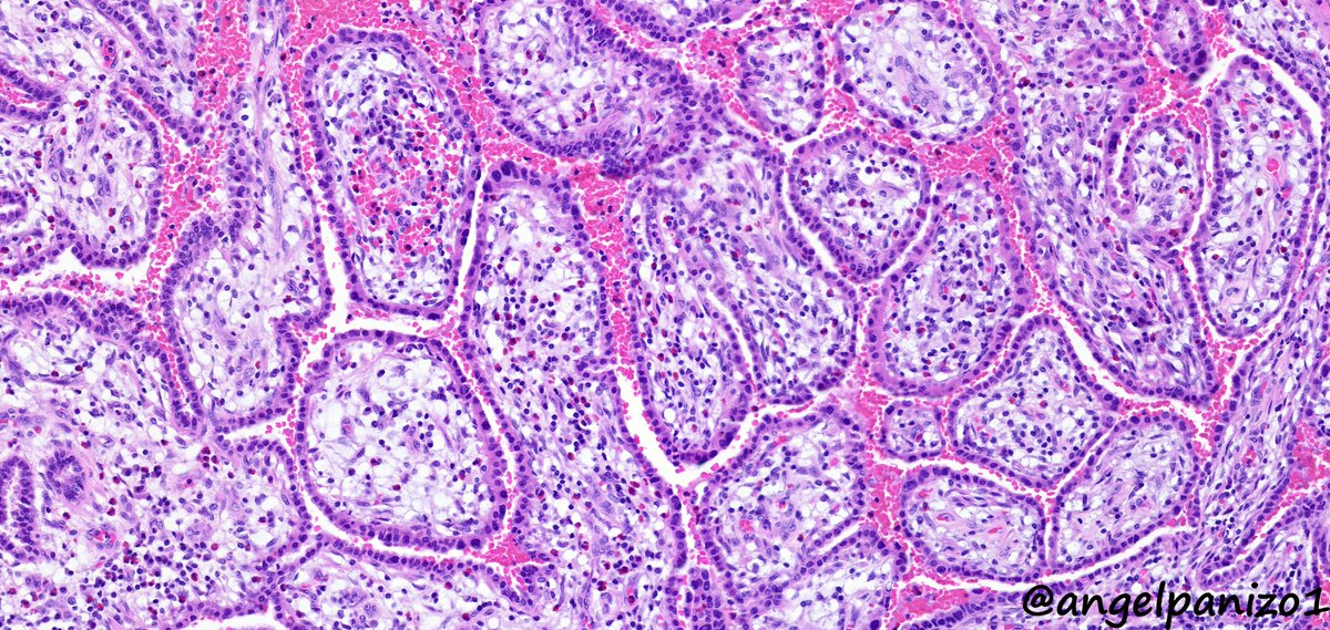 angelpanizo1's tweet image. Incidental lung tumor... pulmonary hamartoma with unusual morphology?... what is your opinion? (2⃣) #PathTwitter  #pulmpath @smlungpathguy @SansanoValero @yro854 @natasharekhtman @mkbaine @atman_ci @Path_Matt
