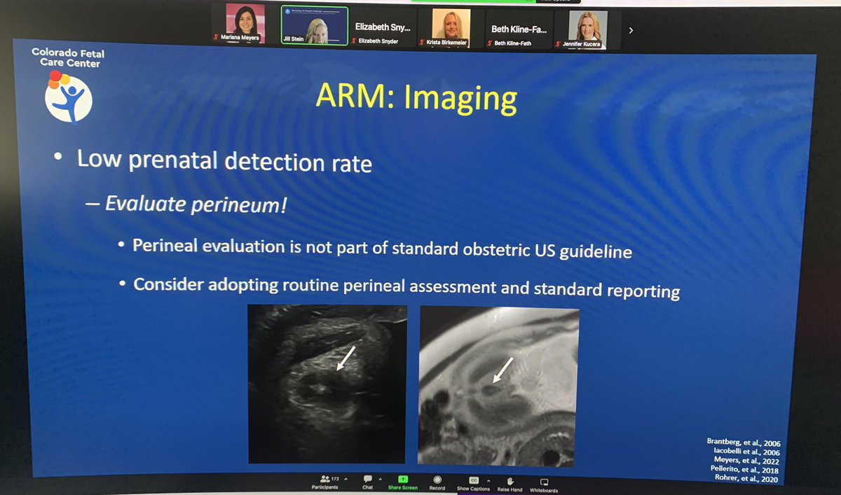 Great talk by Dr. Jill Stein on anorectal malformations and the importance in identifying the anal dimple #analdimpleimaging #SPRFetal2023