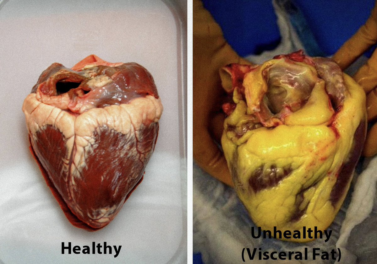 How to stop toxic visceral fat from giving you brain fog, low energy, &amp; anxiety in 8 ways.. 

(And why it’s so dangerous):

THREAD