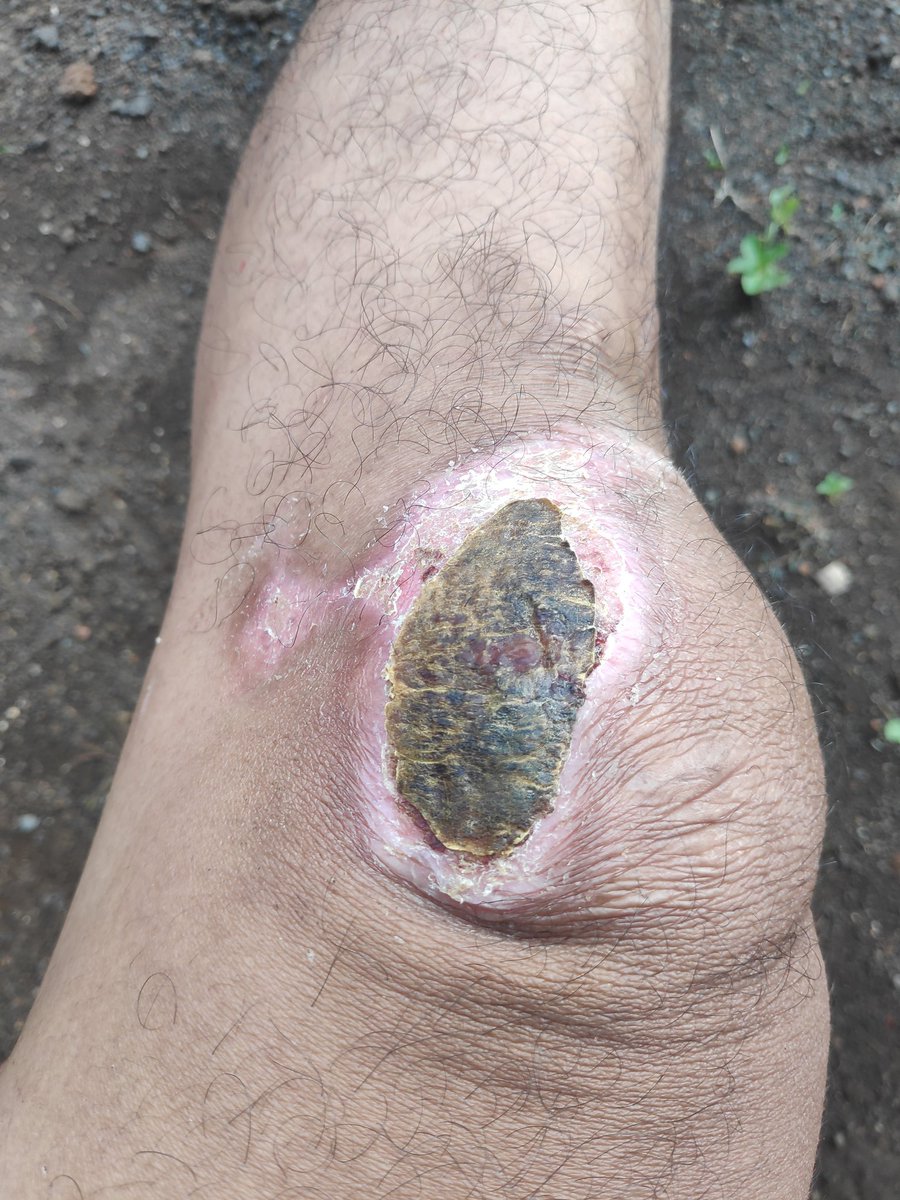 Lama juga hari ke 14 masih belom ngelupas semua