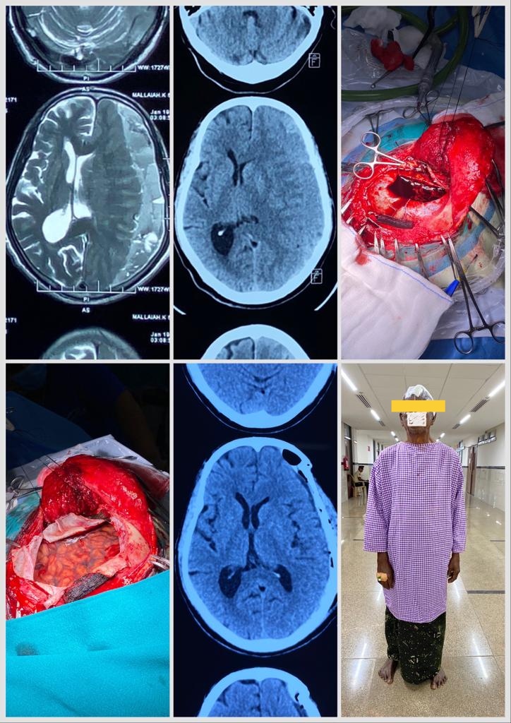mangalAiimsAP's tweet photo. Dept.of Neurosurgery has performed craniotomy procedure for the first time on 69/M who presented to casualty with acute onset Aphasia &amp; Right hemiparesis. Hematoma evacuated &amp; the patient is doing well post surgery
@MoHFW_INDIA 
@mansukhmandviya 
@DrBharatippawar @PMOIndia @ANI https://t.co/NP3ynRECIn