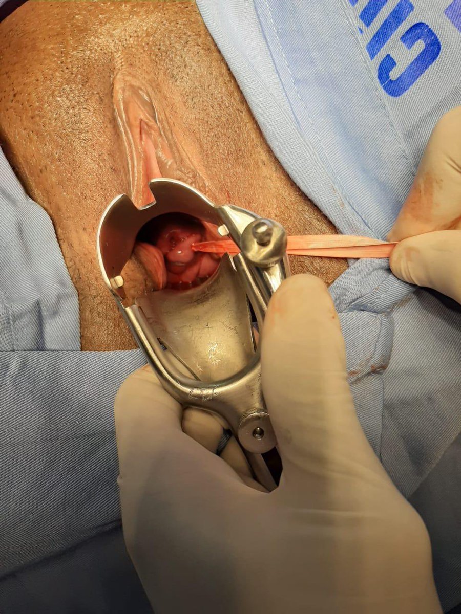JezidMiranda's tweet photo. Así luce una insuficiencia cervical con exposición de membranas en una gestación de 21 semanas. Madre ASINTOMÁTICA.

La única esperanza de manejo: Cerclage cervical de emergencia.🙏😇 https://t.co/0sCAW4hDil