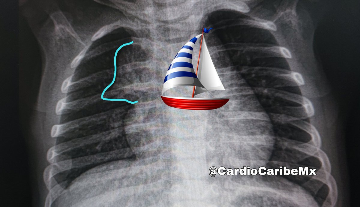 CardioCaribeMx's tweet image. La sombra o vela tímica puede observarse de forma normal en pacientes menores de 2 años. 

En la proyección AP el timo tiene densidad de partes blandas que se proyecta a ambos lados del mediastino superior (4 EIC). #CardioPedMx
