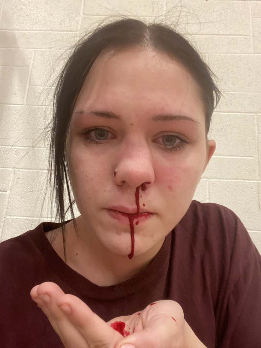 LEATH3RMTHWHXRE's tweet photo. i broke my nose at cheer. warning my nose is bleeding under the warning ���� https://t.co/Afl2pITGAP